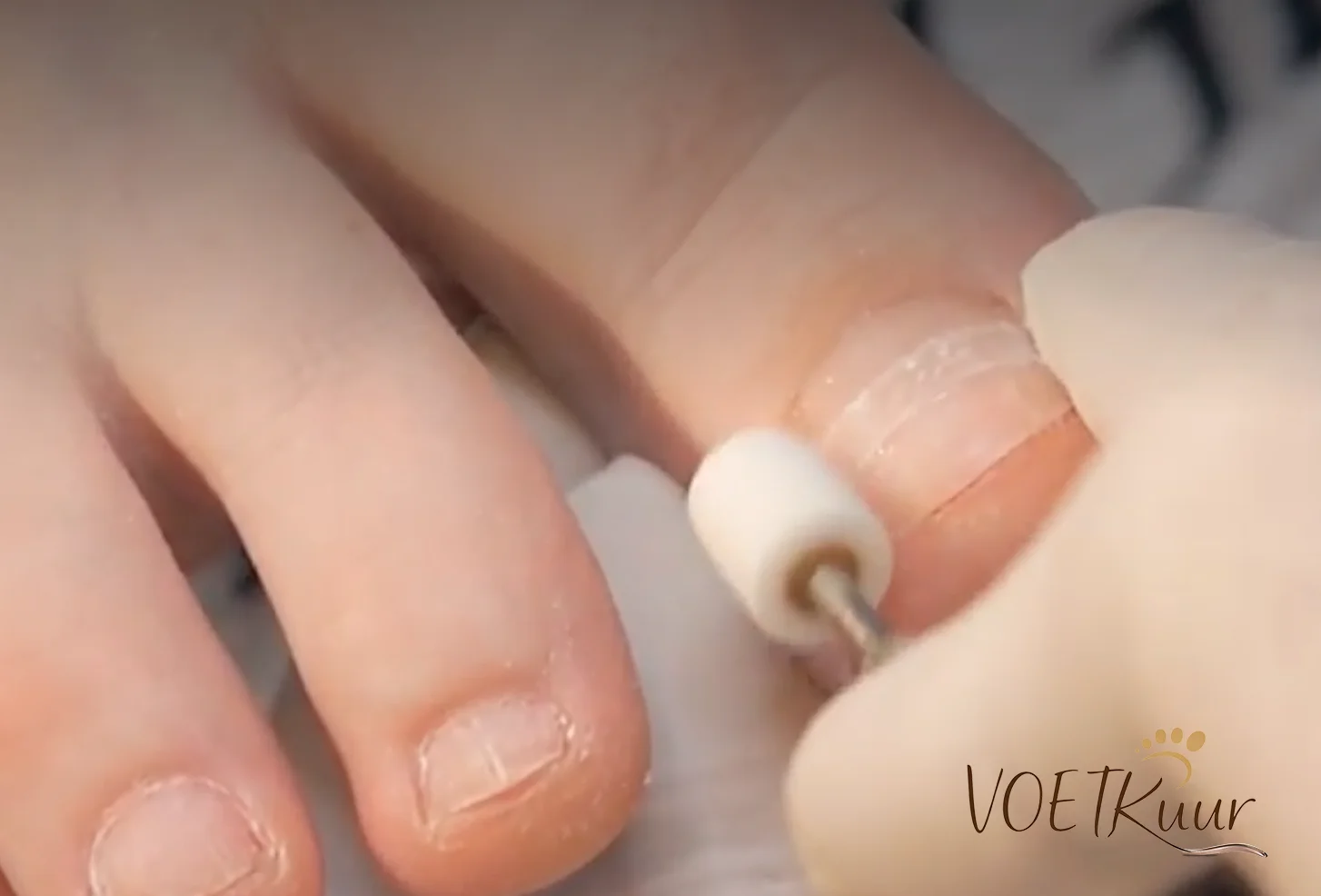Voetkuur Affligem | Speciale Tecnieken Nagelbeugel